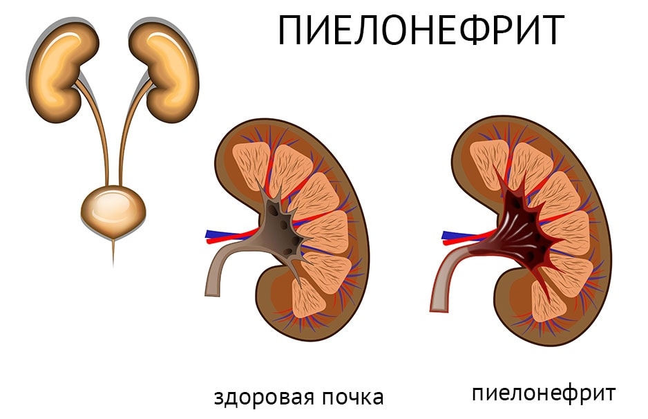 Урологический сбор при пиелонефрите и беременности (фитонефрол)