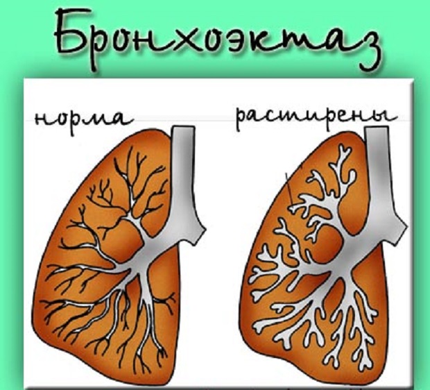 Варикозные Бронхоэктазы