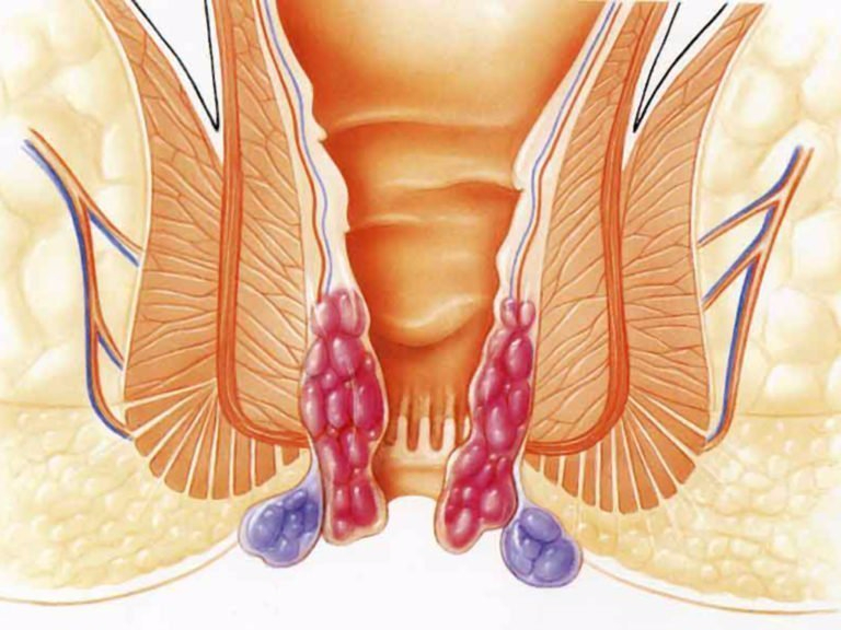 Выпадения из анального канала