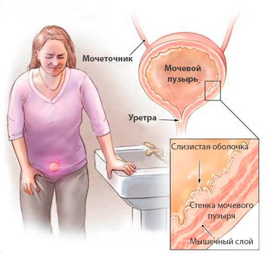 Цистит: симптомы и лечение