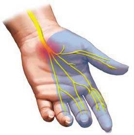 Туннельный синдром: как с ним бороться